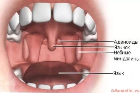 аденоидная ткань у ребенка фото